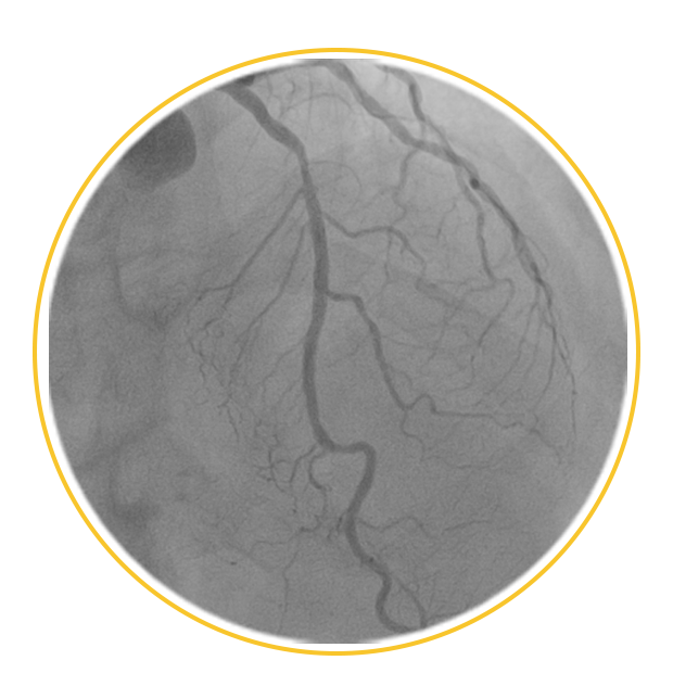 angio circle 2 angio circle 2